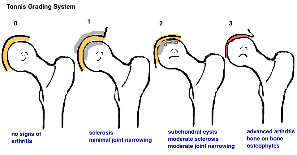 tonnis grading for hip osteoarthritis